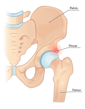 Lesiones de cadera y pelvis, traumatología