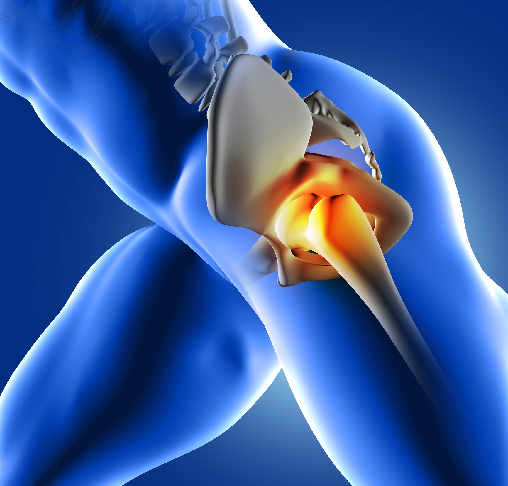 hip replacement in Almeria - run