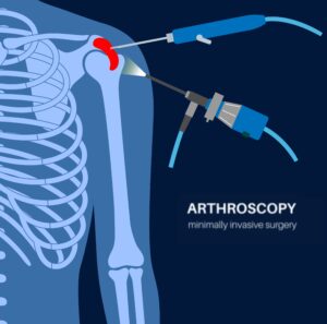 Shoulder arthroscopy in Almeria - arthoscopy