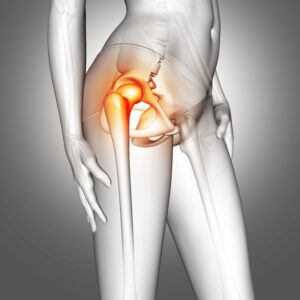 hip replacement in Almeria - 3D